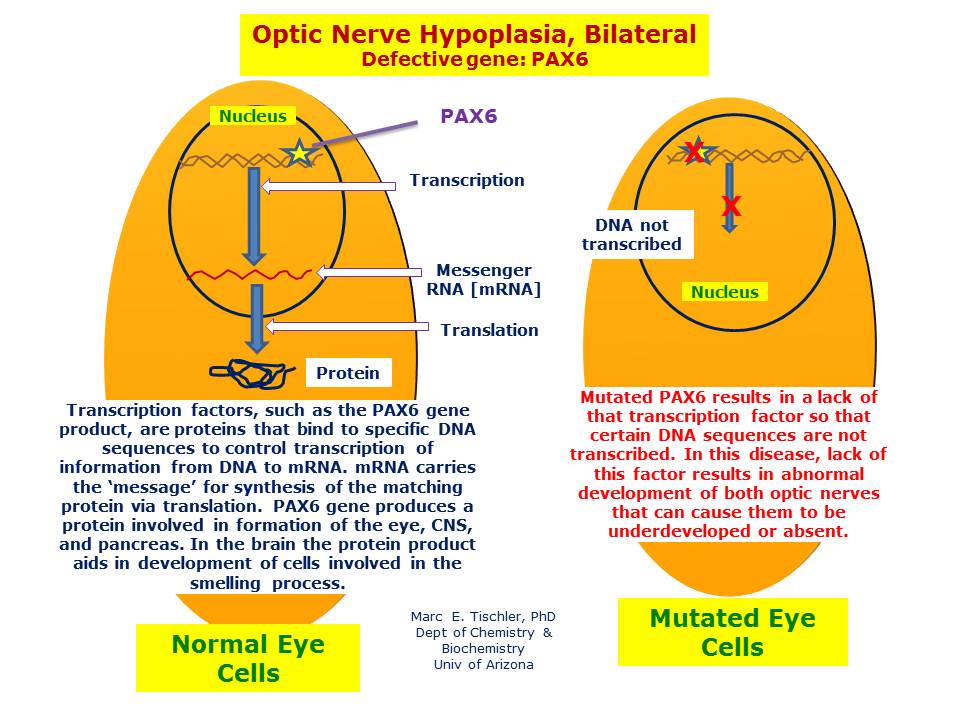 optic-nerve-hypoplasia-bilateral-hereditary-ocular-diseases